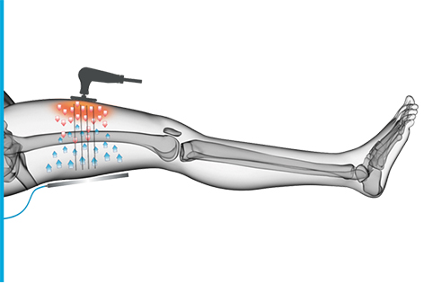 Tecar 2.1 Fisioterapia cet ret rf terapia alívio de dor fisioterapia inteligente 448khz Máquina tecar