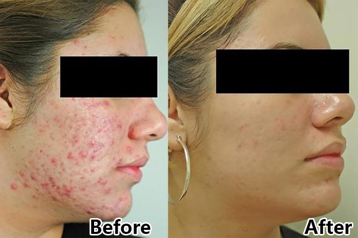 Máquina facial de terapia de luz LED PDT aprovada pela CE para rejuvenescimento da pele e tratamento de acne