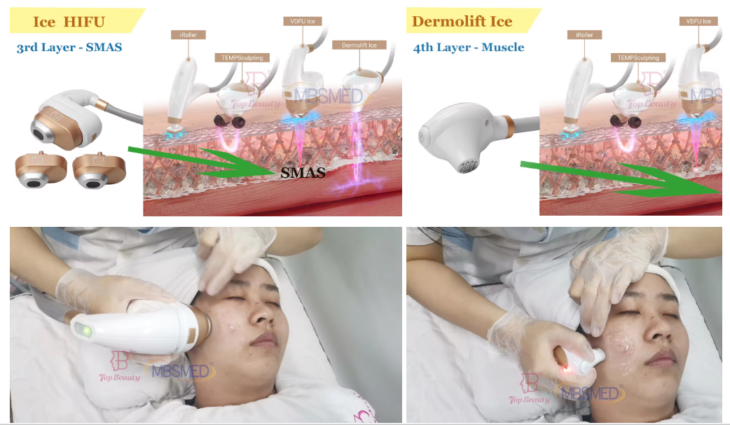 Máquina HIFU 12D ICE para levantamento facial, aperto da pele HIFU