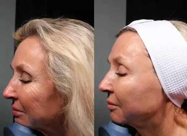 Aparelho de beleza 8D HIFU Vmax para levantamento facial, remoção de rugas e emagrecimento corporal com ultrassom de alta intensidade