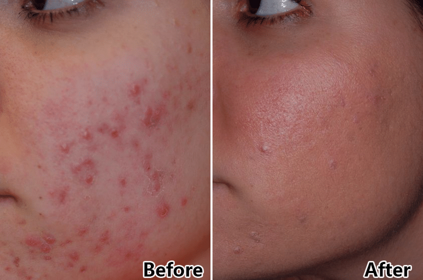 tratamento duplo plano terapia de luz facial com fótons PDT 7 Cores Terapia de Luz Facial LED Dispositivo de Beleza