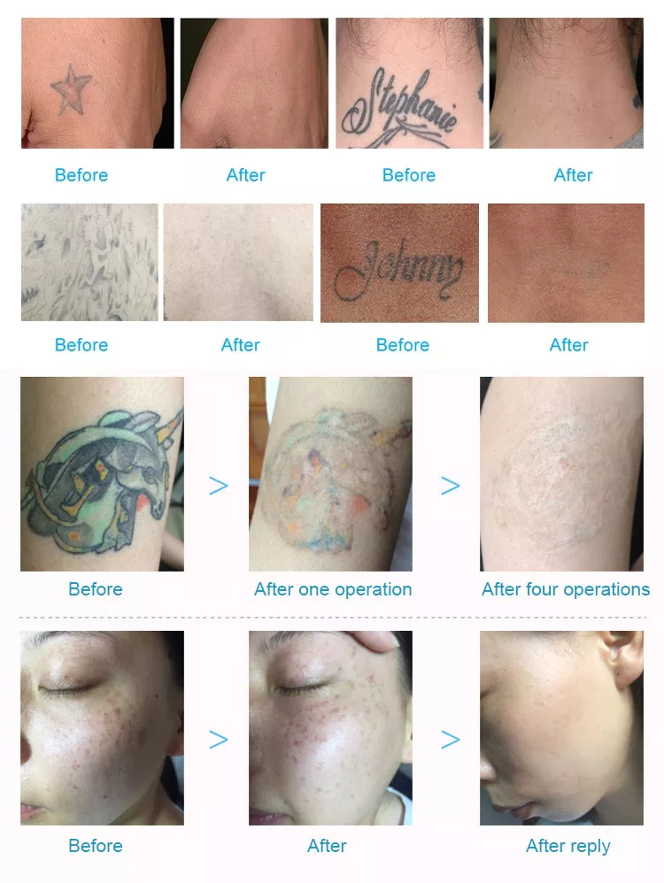antes e depois