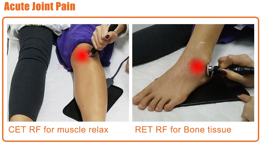 Terapia Tecar Physio Monopolar RF Resistiva e Capacitiva Máquina Tecarterapia Profissional