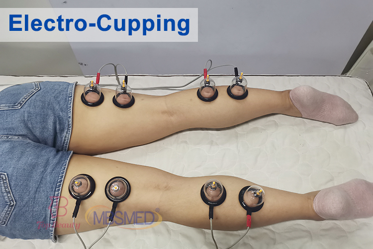 Estimulador Muscular EMS para Redução Corporal Onda Russa Eletroestimulação Terapia a Vácuo de Seios com Ventosa