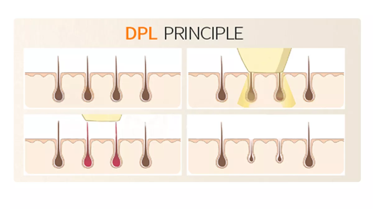 máquina de depilação a diodo DPL rejuvenescimento da pele lifting anti-rugas e máquina de beleza