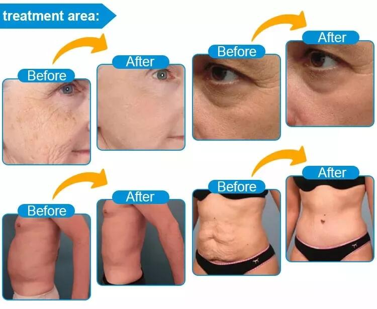 Aparelho de beleza 8D HIFU Vmax para levantamento facial, remoção de rugas e emagrecimento corporal com ultrassom de alta intensidade