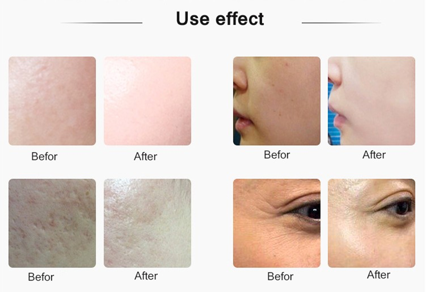Dispositivo de cuidados com a pele com pistola de injeção de mesoterapia por radiofrequência com microagulhas por ultrassom