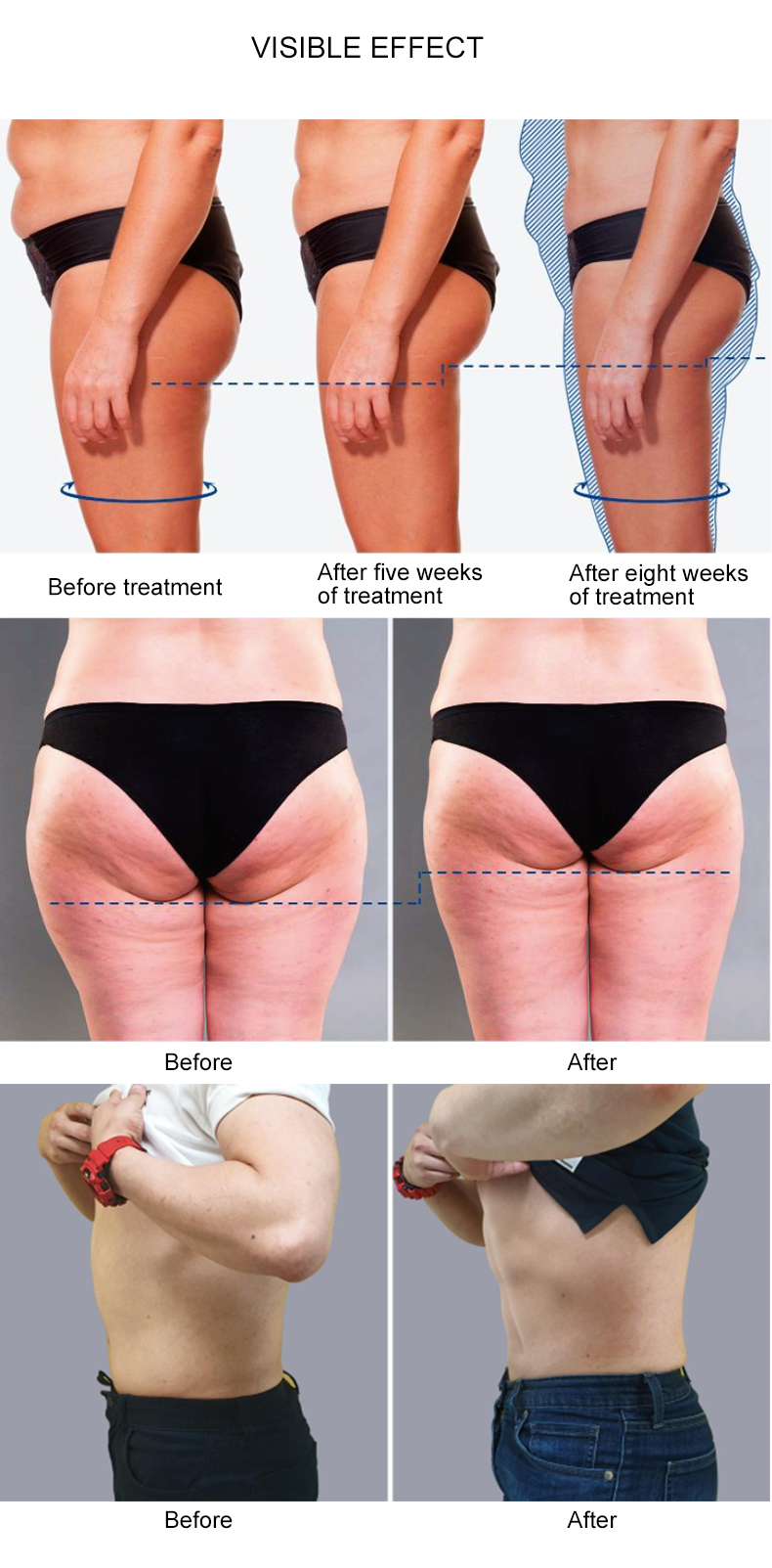 Máquina de terapia 2 em 1 smas RF shockwave para celulite