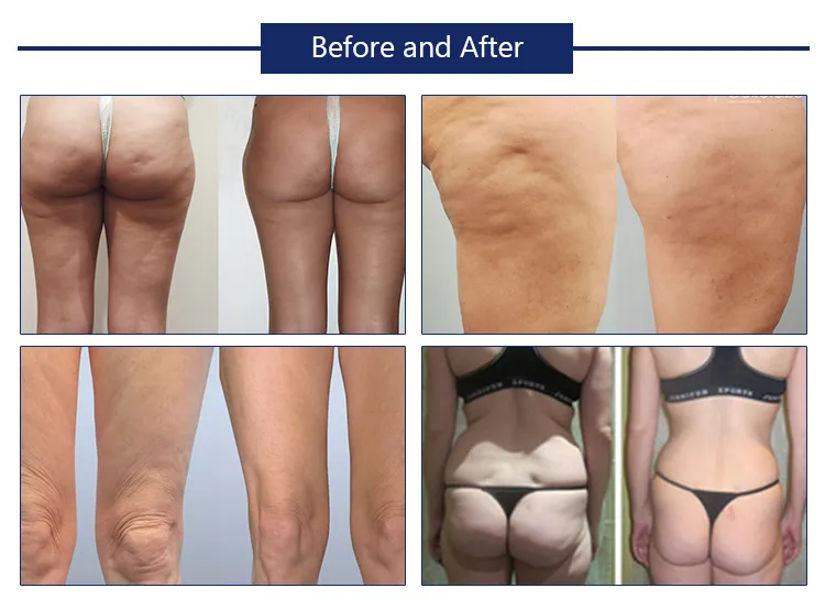Melhor preço máquina de emagrecimento cryolipólise crioterapia perda de peso congelamento de gordura