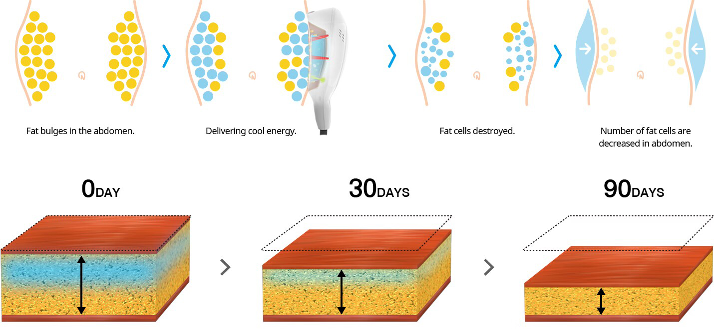 Melhor preço máquina de emagrecimento cryolipólise crioterapia perda de peso congelamento de gordura