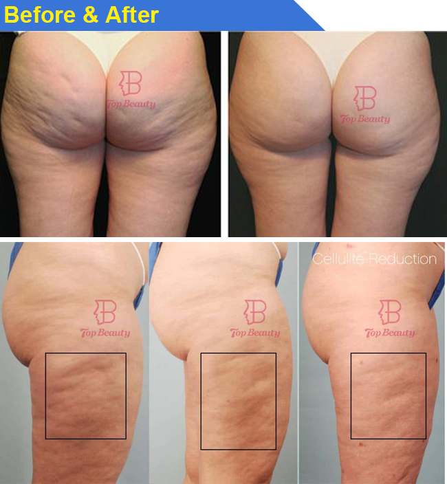Máquina de celulite de massagem com rolo Endospheres