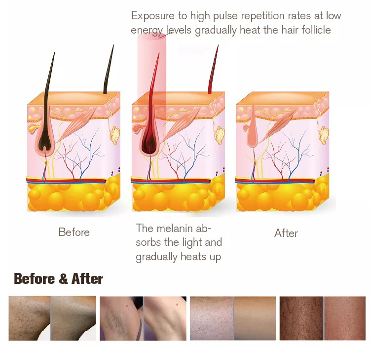 Nova máquina de remoção de cabelo IPL de terapia de luz pulsada intensa