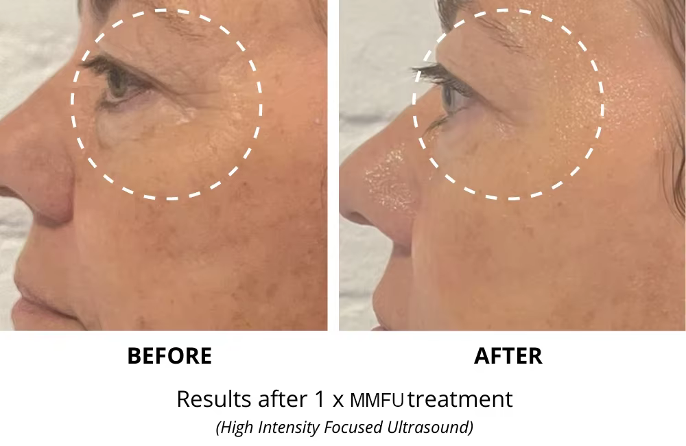 Máquina de levantamento facial 2 em 1 7D hifu RF hifu face e corpo apertam a máquina