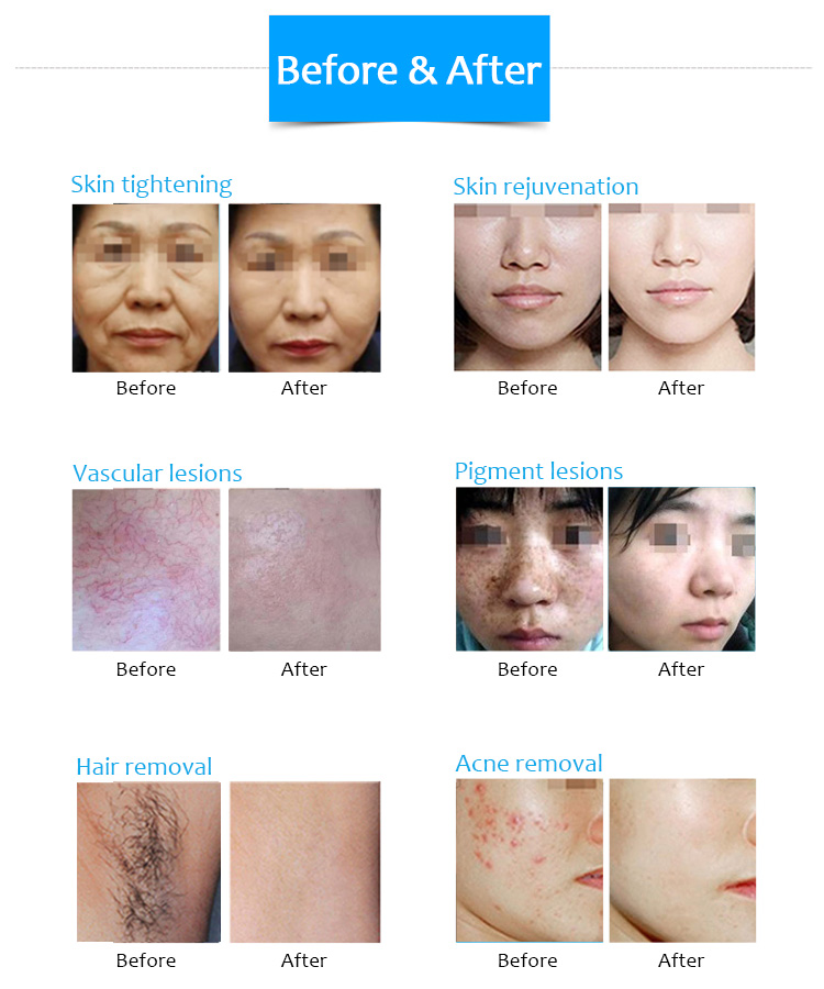 máquina de depilação a diodo DPL rejuvenescimento da pele lifting anti-rugas e máquina de beleza