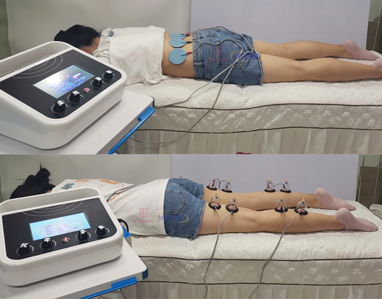 Estimulador Muscular EMS para Redução Corporal Onda Russa Eletroestimulação Terapia a Vácuo de Seios com Ventosa