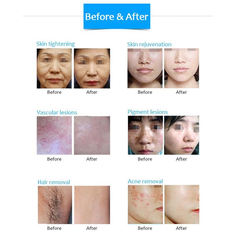 máquina de depilação a diodo DPL rejuvenescimento da pele lifting anti-rugas e máquina de beleza