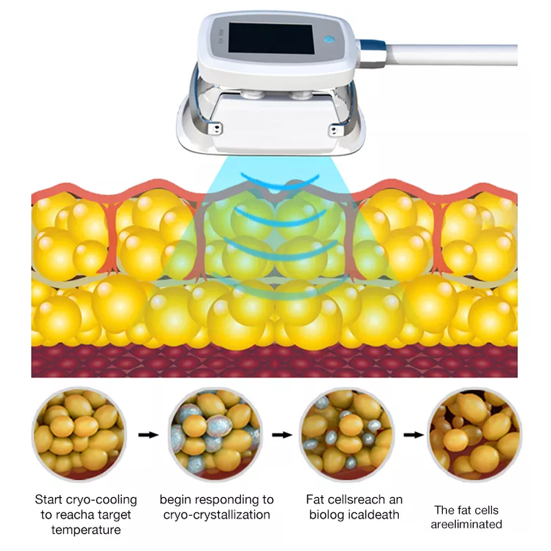 Máquina Cryo 360 de 2022 Cryolipólise Melhor Preço Máquina de Congelamento de Gordura Para Perda de Peso Cryolipólise