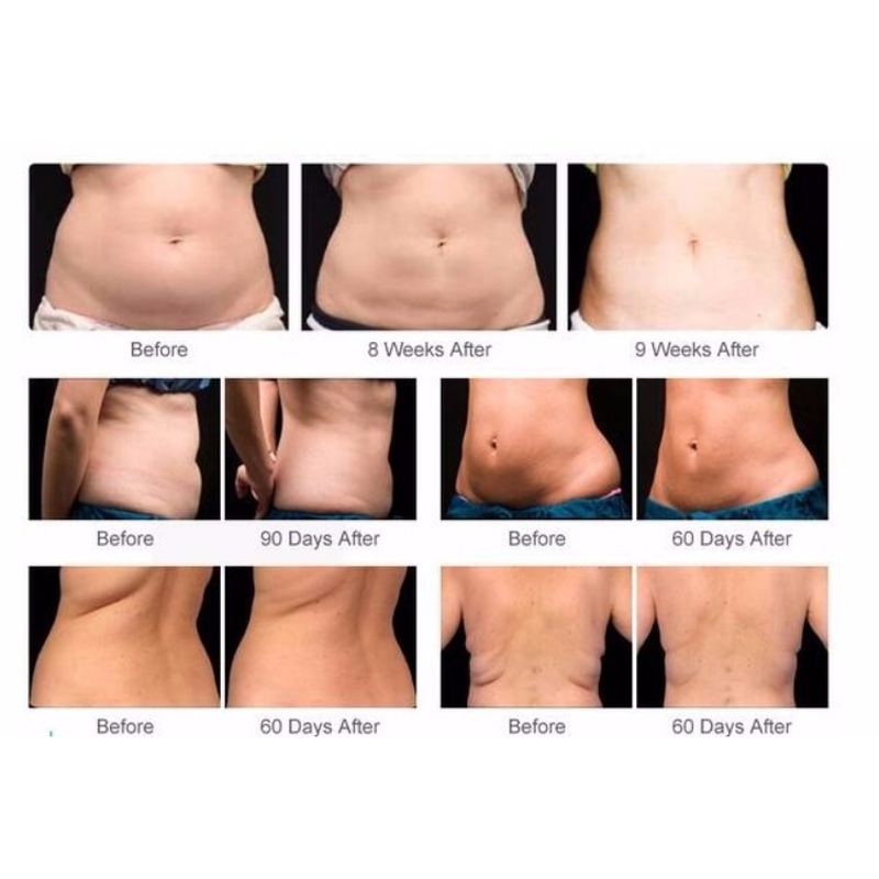 Melhor preço máquina de emagrecimento cryolipólise crioterapia perda de peso congelamento de gordura