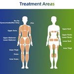 Tratamento Trushape ID Ems Estimulação Elétrica Muscular Escultura Corporal Máquina Emslim