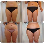 Equipamento profissional de estimulação muscular elétrica Trusculpt ID EMS para modelagem corporal