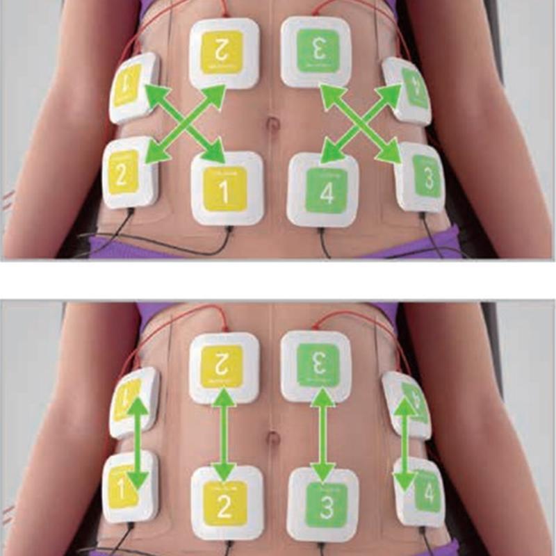 Equipamento profissional de estimulação muscular elétrica Trusculpt ID EMS para modelagem corporal