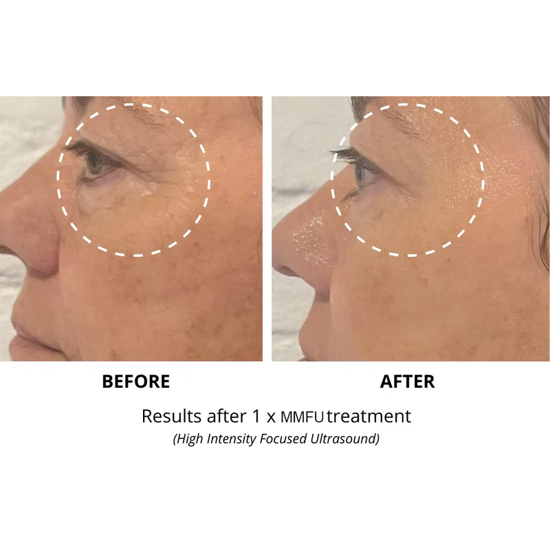 Máquina de levantamento facial 2 em 1 7D hifu RF hifu face e corpo apertam a máquina