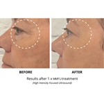 Máquina de levantamento facial 2 em 1 7D hifu RF hifu face e corpo apertam a máquina