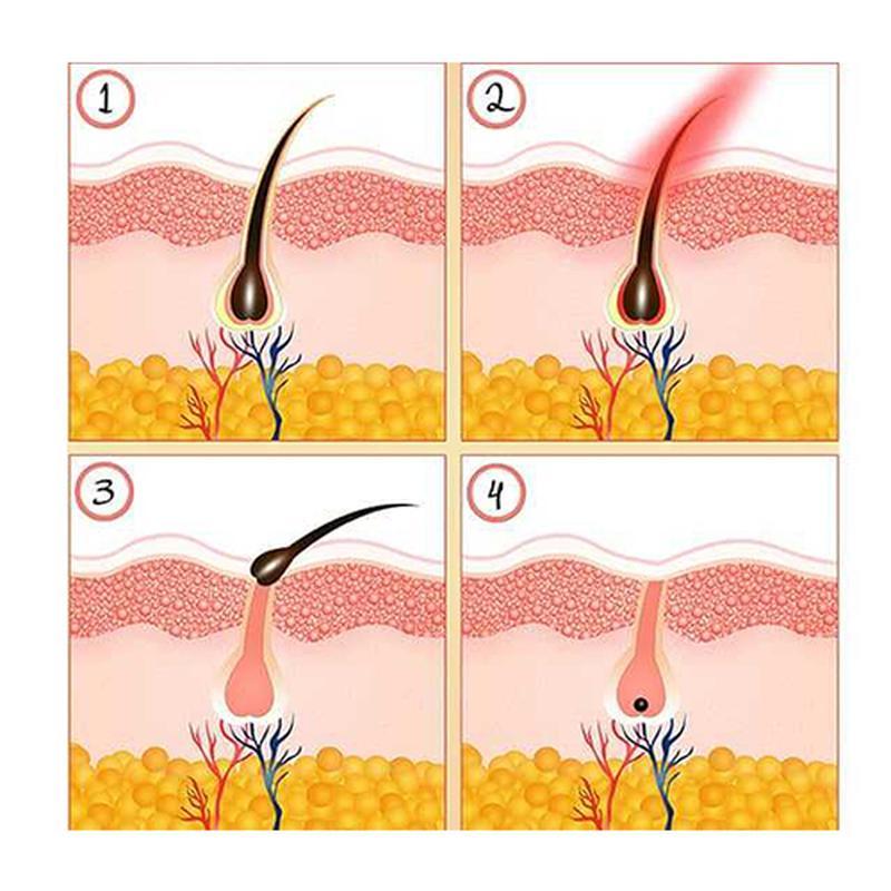 Nova máquina de remoção de cabelo IPL de terapia de luz pulsada intensa