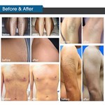 Nova máquina de remoção de cabelo IPL de terapia de luz pulsada intensa