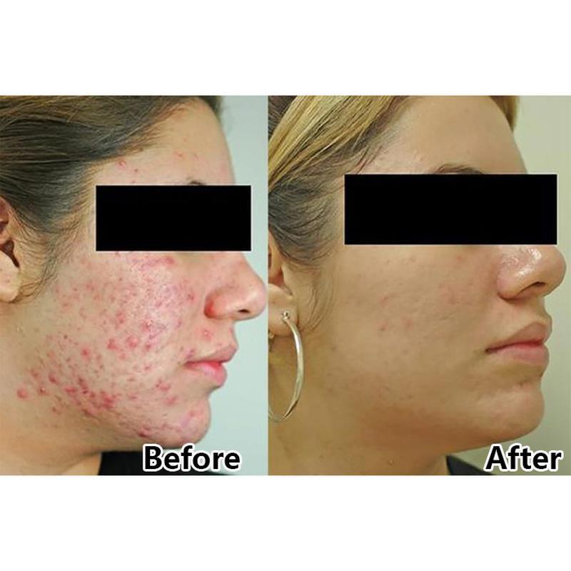 Máquina facial de terapia de luz LED PDT aprovada pela CE para rejuvenescimento da pele e tratamento de acne