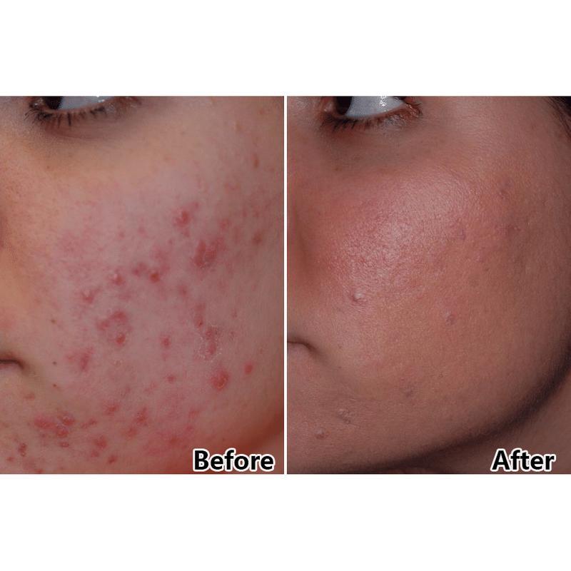 tratamento duplo plano terapia de luz facial com fótons PDT 7 Cores Terapia de Luz Facial LED Dispositivo de Beleza