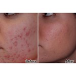 tratamento duplo plano terapia de luz facial com fótons PDT 7 Cores Terapia de Luz Facial LED Dispositivo de Beleza
