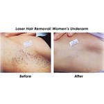 Máquina profissional de remoção de cabelo a laser de diodo 808nm