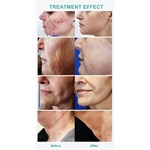 Máquina Profissional de Microneedling RF para Remoção de Cicatrizes e Rejuvenescimento da Pele