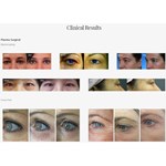 Máquina de Levantamento de Olhos com Caneta de Plasma para Tratamento de Pele e Acne