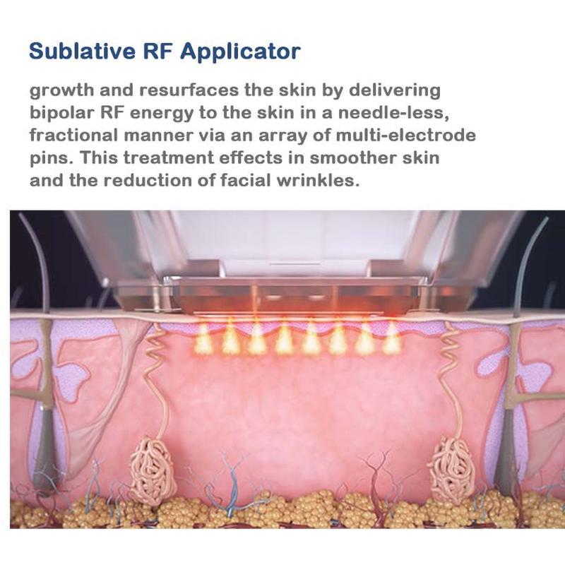 Remoção de rugas da pele com Matrix de Microneedling por Radiofrequência (RF)