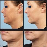 Remoção de rugas da pele com Matrix de Microneedling por Radiofrequência (RF)