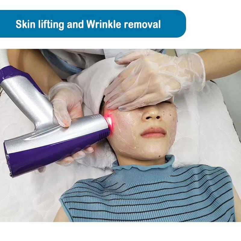 Remoção de rugas da pele com Matrix de Microneedling por Radiofrequência (RF)
