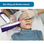 Remoção de rugas da pele com Matrix de Microneedling por Radiofrequência (RF)