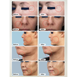 Sistema de RF Microagulhas + Thermagia Fractional RF para Microneedling de RF e Equipamento de Beleza com Frequência de Rádio Fracionada