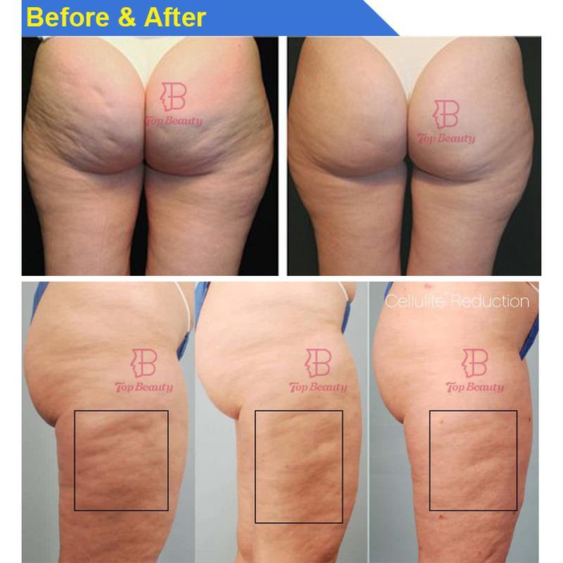 Máquina de celulite de massagem com rolo Endospheres