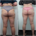 Máquina de Drenagem Linfática Endosphere para Modelagem Corporal Roller de Bola Interna Massagem Muscular Equipamento de Redução de Celulite e Emagrecimento