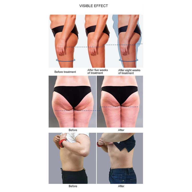 Máquina profissional portátil de estimulação muscular e redução corporal com EMS de alta potência